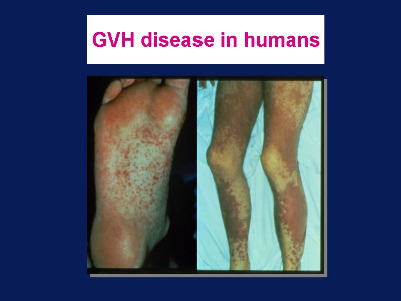 GVH disease in humans